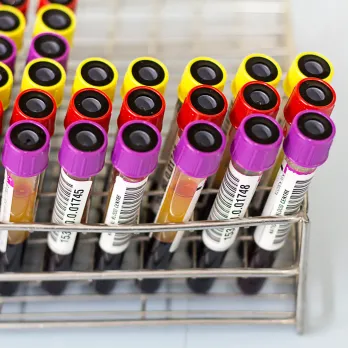 Colorful specimen tubes with purple and yellow caps in medical rack